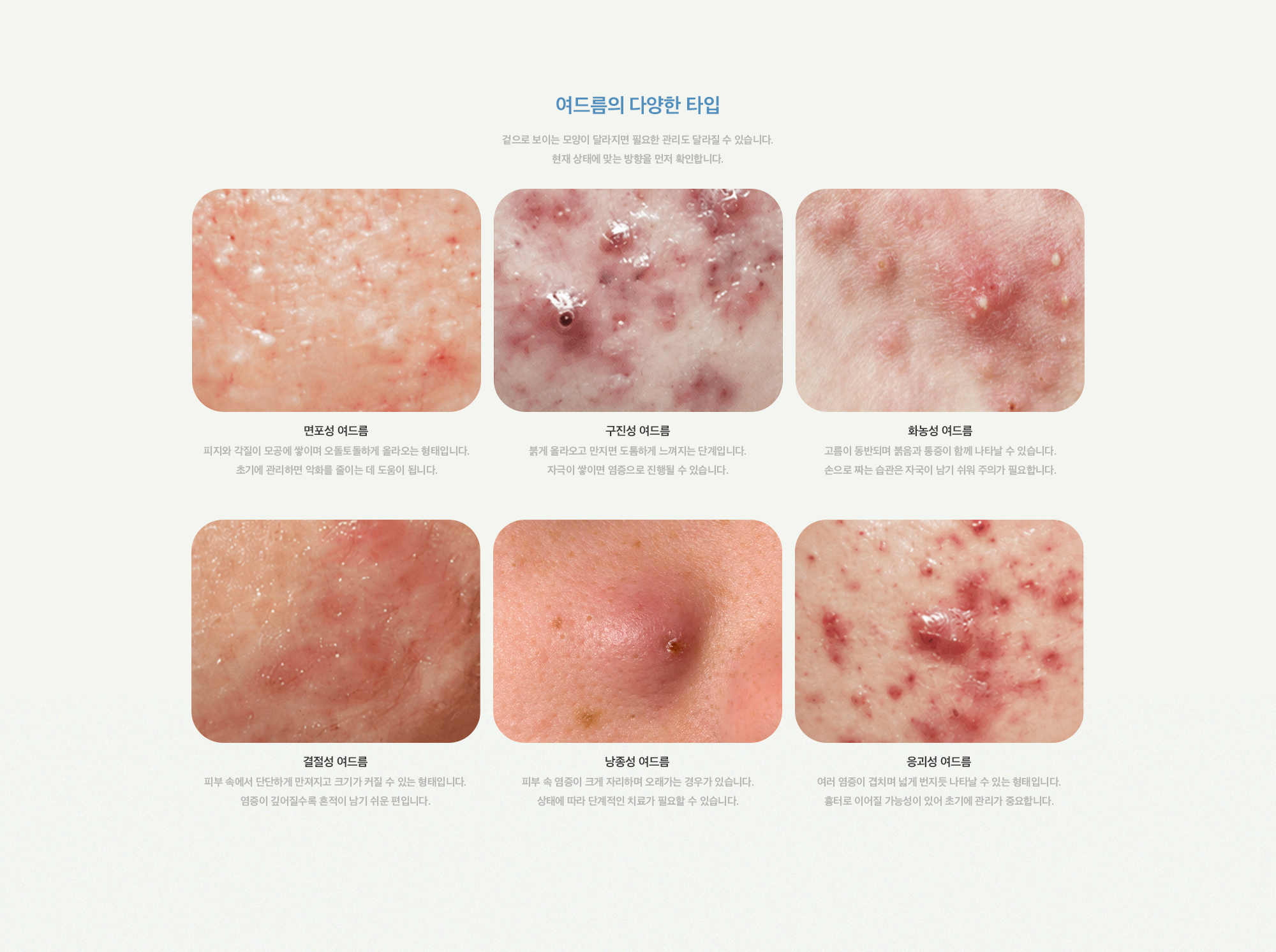 [여드름의 다양한 타입] 면포성 여드름, 구진성 여드름, 화농성 여드름, 결절성 여드름, 낭종성 여드름, 응괴성 여드름