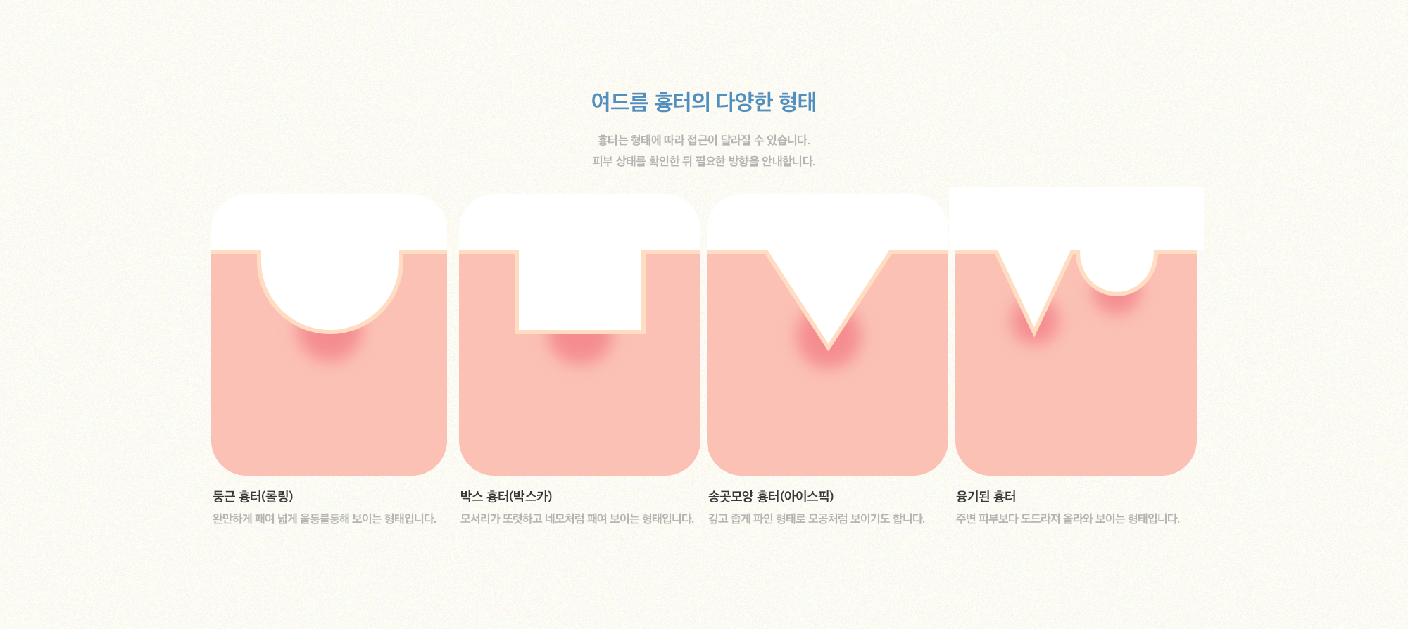 [여드름 흉터의 다양한 형태] 둥근 흉터(롤링), 둥근 흉터(롤링), 송곳모양 흉터(아이스픽), 융기된 흉터